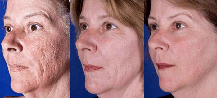 Results after a laser facial skin rejuvenation procedure